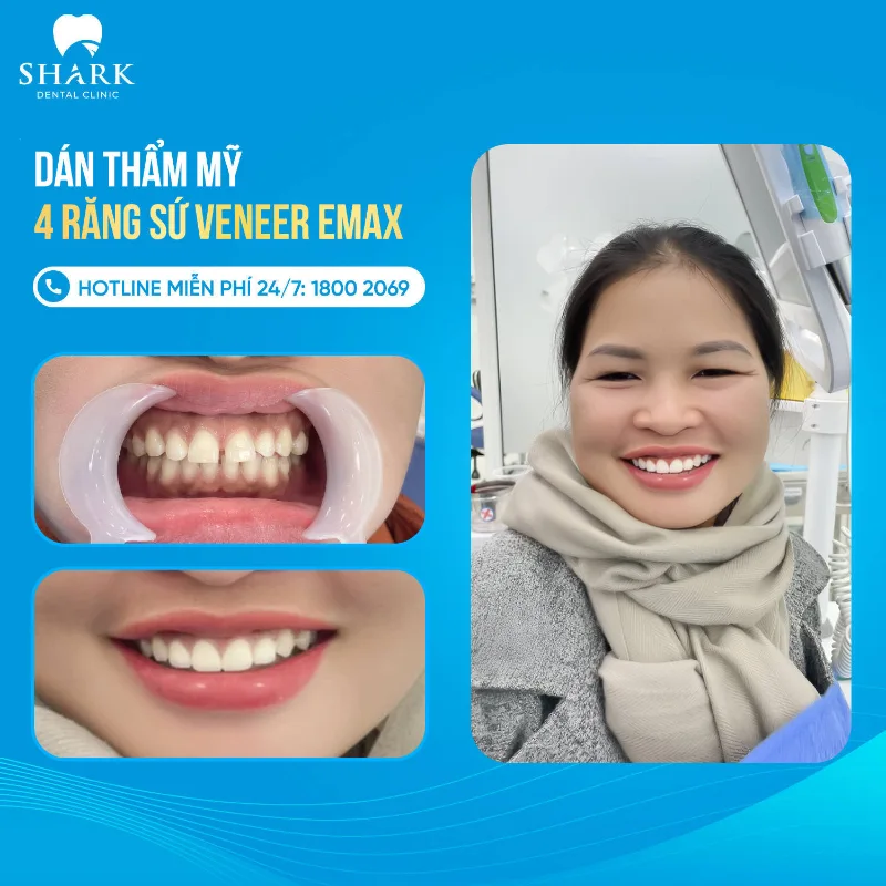 Chị Huyền dán 4 răng sứ Veneer Emax