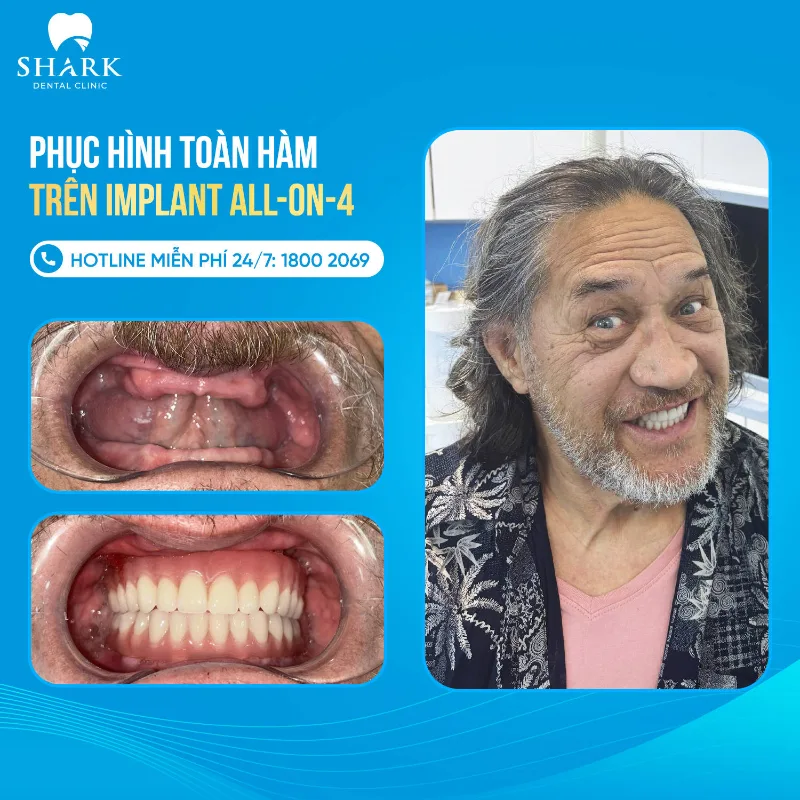Phục hình toàn hàm trên Implant all on 4