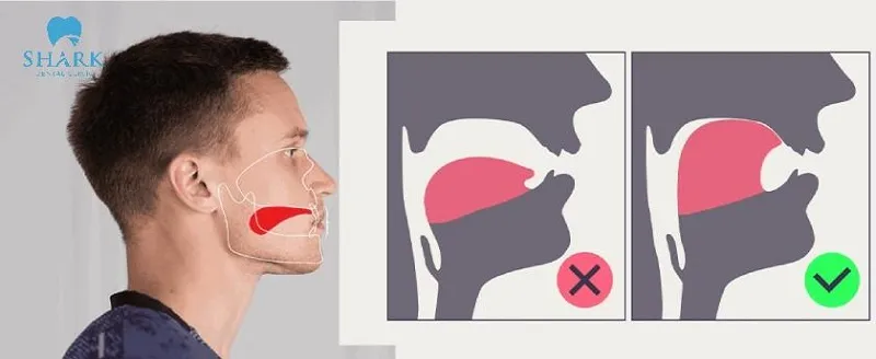 Kỹ thuật mewing được nhiều người lựa chọn bởi tính hiệu quả cao