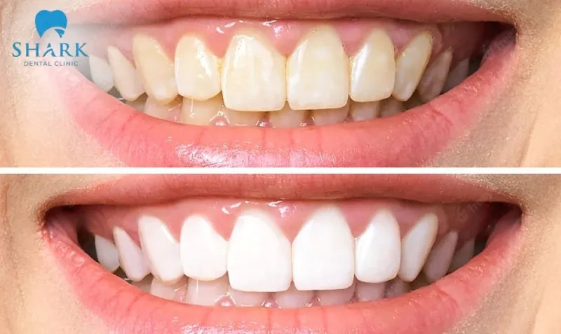Có nên sử dụng miếng dán trắng răng Crest không? 8 Sản phẩm miếng dán trắng răng này có hiệu quả làm trắng rõ rệt chỉ sau 1 liệu trình sử dụng