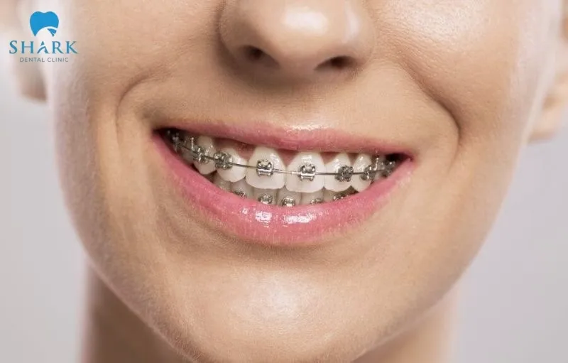 Tính cách và vận mệnh của người nói chuyện không hở răng 12 Niềng răng thẩm mỹ mang lại hiệu quả cao và đòi hỏi một quá trình lâu dài