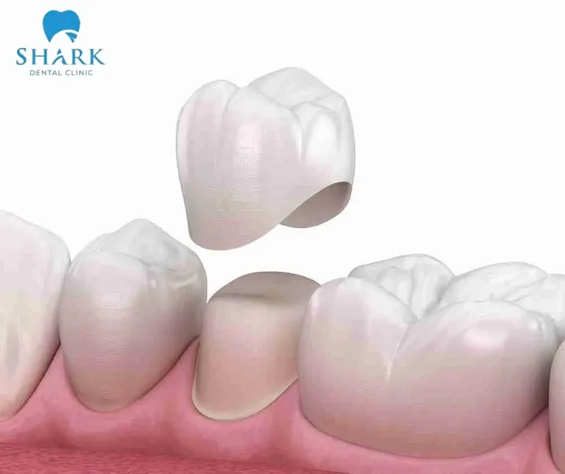 Tính cách và vận mệnh của người nói chuyện không hở răng 13 Bọc sứ thẩm mỹ là phương pháp cải thiện nụ cười hiệu quả