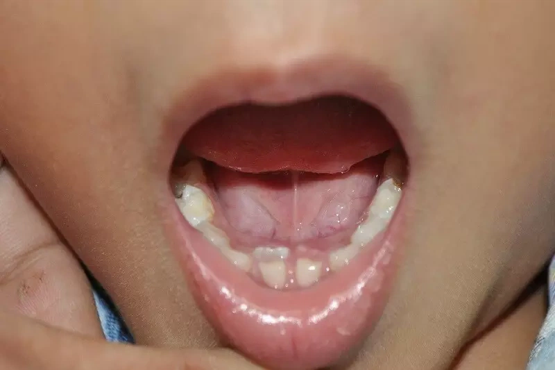 Răng mọc lẫy phải làm sao? Có nên nhổ cho bé không? 7 Răng mọc lẫy là tình trạng răng sữa chưa rụng mà răng vĩnh viễn đã mọc