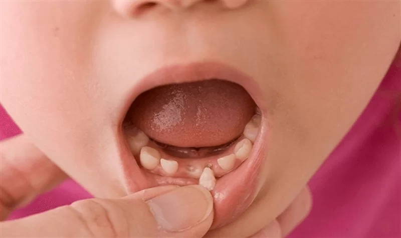 Răng mọc lẫy phải làm sao? Có nên nhổ cho bé không? 11 Răng mọc lẫy có nhổ được không tuỳ thuộc vào nhiều yếu tố