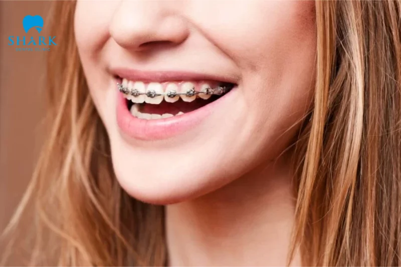 Niềng răng mắc cài kim loại là gì? Có những loại nào? 8 Metal braces