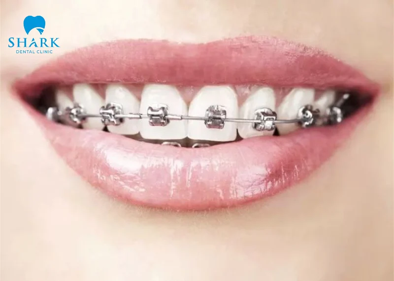 Niềng răng mắc cài kim loại là gì? Có những loại nào? 10 Mắc cài tự động có cấu tạo tiên tiến hơn