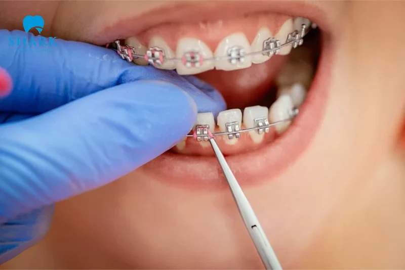 Niềng răng mắc cài kim loại là gì? Có những loại nào? 9 Mắc cài kim loại truyền thống có sử dụng thun buộc