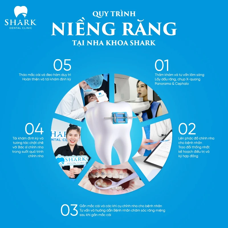 Niềng răng mắc cài kim loại là gì? Có những loại nào? 12 Quy trình niềng răng chuẩn y khoa