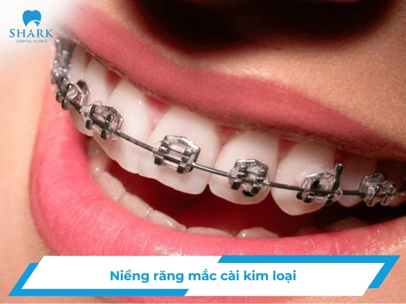 Metal braces