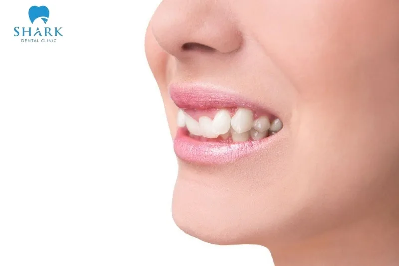Răng 9630 là gì? Nguyên nhân và cách khắc phục hiệu quả 7 Răng 9630 là tình trạng răng mọc lệch lạc, khấp khểnh, chen chúc trên cung hàm