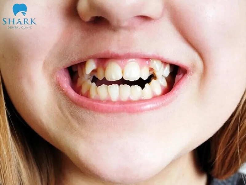 Răng 9630 là gì? Nguyên nhân và cách khắc phục hiệu quả 9 Răng mọc lộn xộn, không đều làm cho nụ cười trở nên kém duyên, mất thẩm mỹ