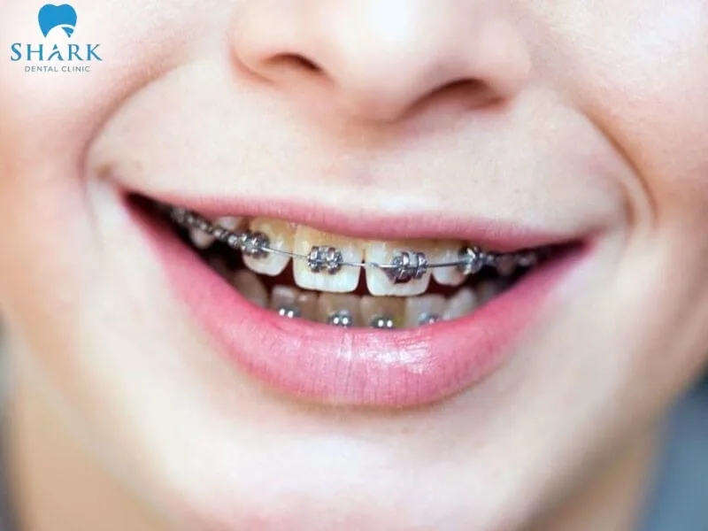 Răng 9630 là gì? Nguyên nhân và cách khắc phục hiệu quả 10 Niềng răng là phương pháp chỉnh nha phổ biến, giúp khắc phục hiệu quả các trường hợp răng mọc chen chúc, mọc lệch phức tạp