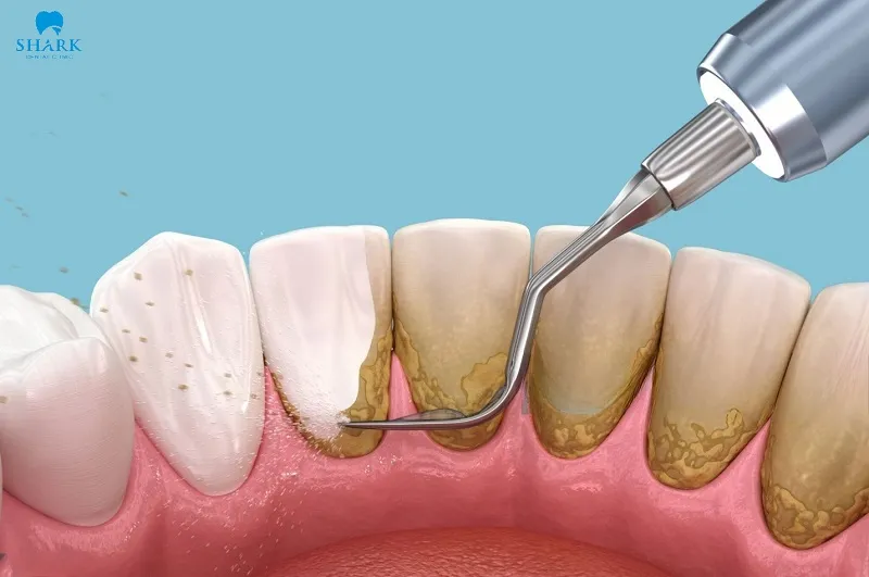 Lấy cao răng giúp loại bỏ mảng bám đen hiệu quả