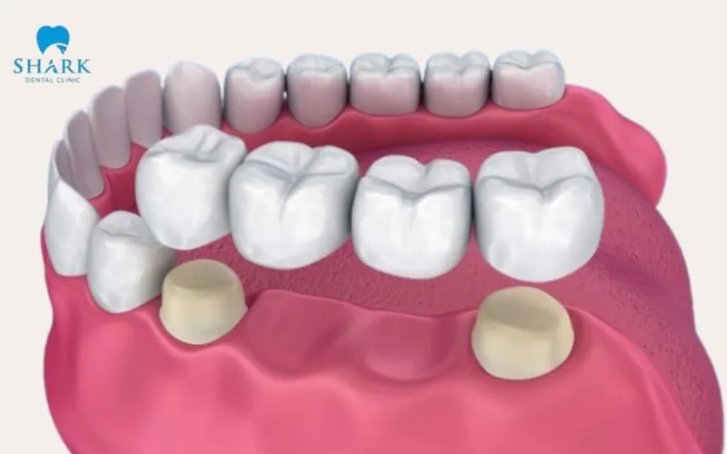 Keo dán nha khoa không chắc chắn sẽ làm mão răng sứ hở viền