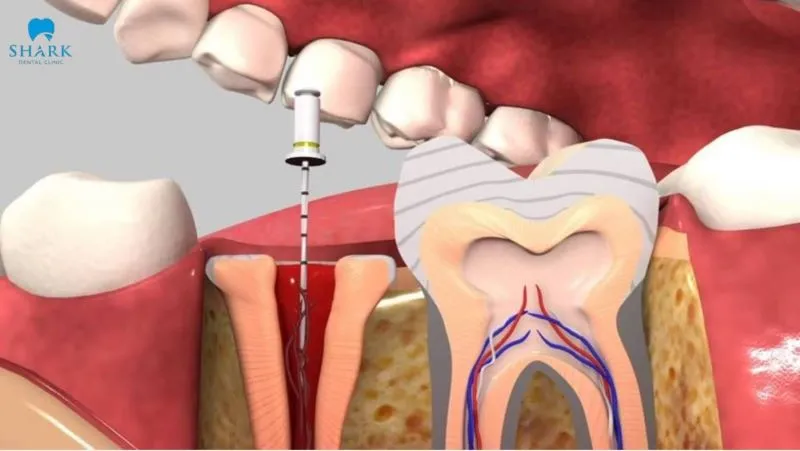 Nhanh chóng điều trị lấy tủy triệt để nếu phát hiện viêm tủy hoặc nhiễm trùng 