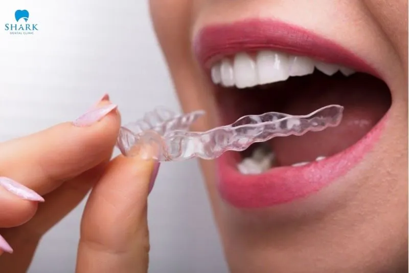 Đeo máng chống nghiến răng giúp hạn chế tình trạng mòn men răng 