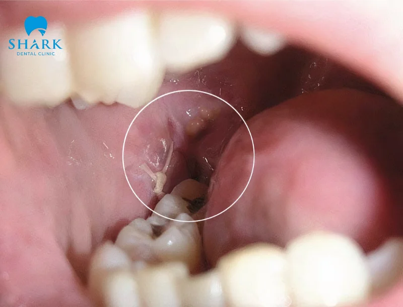Tại sao răng hàm cắn vào má? Răng cắn má trong là điềm gì? 6 Răng cắn vào má là do tình trạng lệch khớp cắn