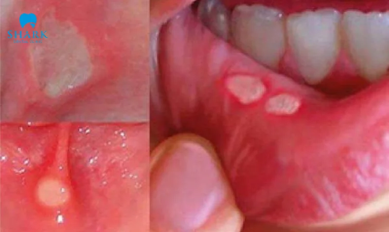 Tại sao răng hàm cắn vào má? Răng cắn má trong là điềm gì? 7 Viêm loét mô mềm khi răng cắn vào má