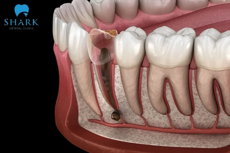 Răng chết tủy có trám được không? Quy trình ra sao? 6 Răng chết tủy là tình trạng tủy răng bị hoại tử do các chấn thương nặng không được phục hồi