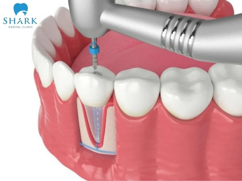 Răng chết tủy có trám được không? Quy trình ra sao? 8 Tùy vào từng tình trạng răng, bác sĩ sẽ tiến hành phục hình theo phương pháp trám răng hoặc bọc răng sứ thẩm mỹ.