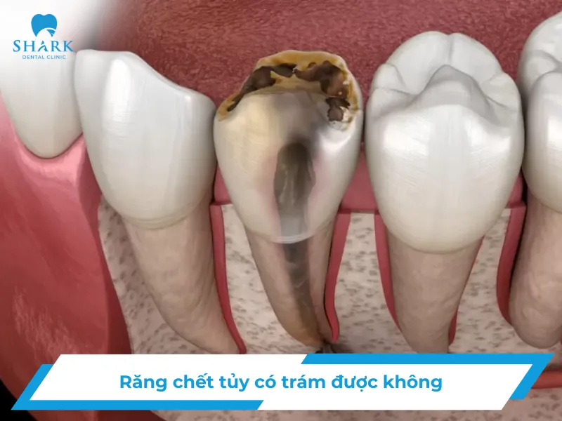 Răng chết tủy có trám được không
