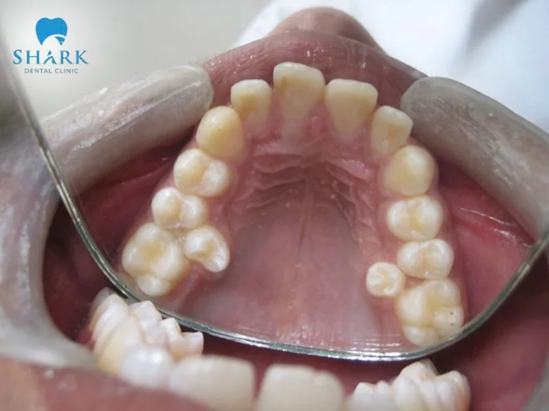 Răng mọc thừa phía trong hàng răng chính gây cản trở trong việc vệ sinh răng miệng và chức năng nhai