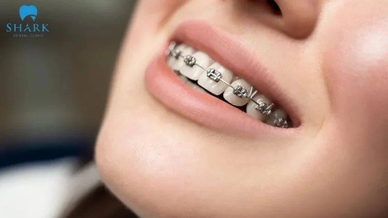 Có thể sử dụng phương pháp niềng răng chỉnh nha giúp điều trị răng mọc thừa