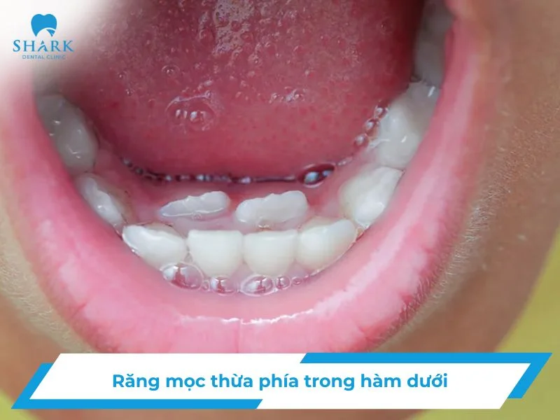 Răng mọc thừa phía trong hàm dưới