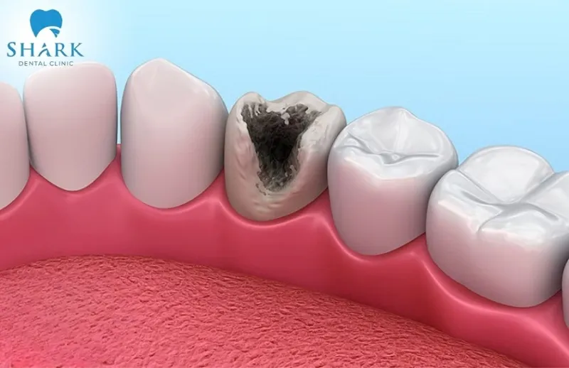 Răng sâu bị vỡ chỉ còn chân răng ảnh hưởng nghiêm trọng đến sức khỏe răng miệng