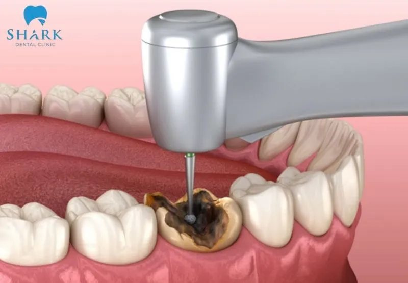 Phần chân răng nếu còn tốt và không bị ảnh hưởng nhiều, có thể thực hiện phục hình theo phương pháp trám răng