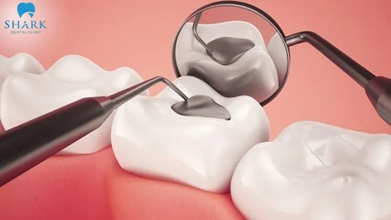 Trám răng giúp bảo tồn được tối đa răng thật