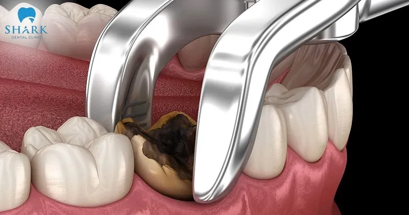 Nhổ răng được thực hiện nhằm bảo vệ các răng lân cận và duy trì sức khỏe xương hàm