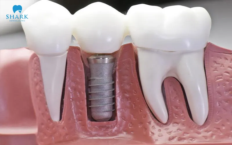 Lựa chọn trụ Implant và mão sứ phù hợp là một trong những lưu ý quan trọng ngăn ngừa nguy cơ đào thải trụ ngoài ý muốn