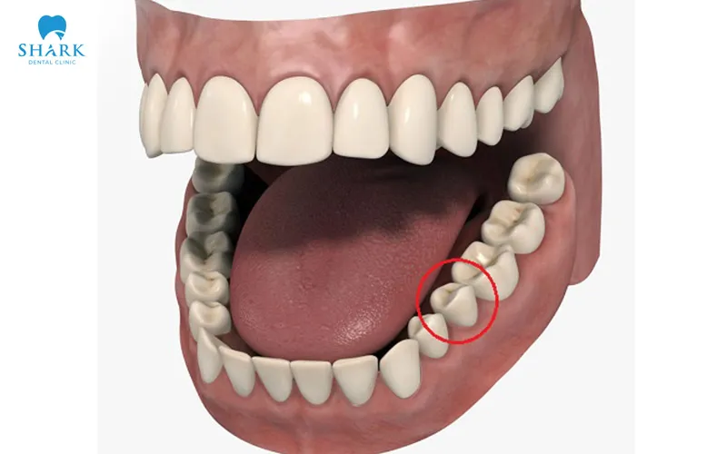 Răng số 5 là chiếc răng nằm ở vị trí số 5 trên cung hàm đảm nhận vai trò cắn và chia nhỏ thức ăn trước khi nghiền