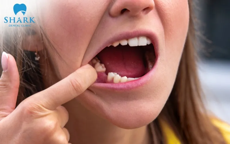 Việc mất răng hàm số 5 mà không có phương pháp phục hình kịp thời có thể khiến các răng khác có xu hướng di chuyển gây lệch hàm