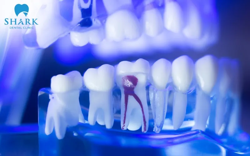 Răng số 5 bị mất có thể khiến lực nhai dồn lên các răng lân cận và chèn ép dây thần kinh bên dưới gây đau nhức, tê mỏi vai gáy