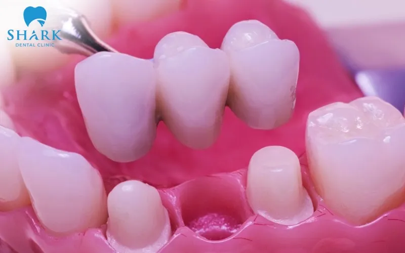 Bắc cầu răng sứ là giải pháp phục hình khá phổ biến giúp cải thiện khả năng ăn nhai đồng thời đáp ứng tính thẩm mỹ cao