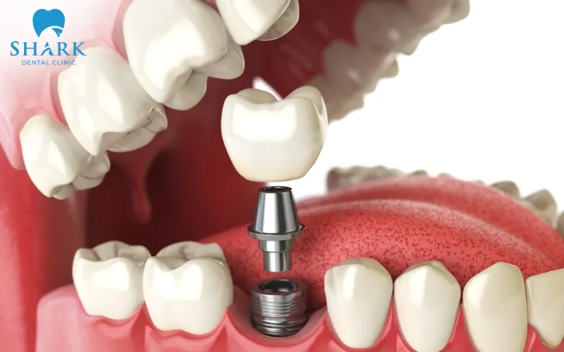 Trồng răng Implant là giải pháp toàn diện để phục hình răng hàm số 5 bị mất một cách vĩnh viễn với hiệu quả vượt trội