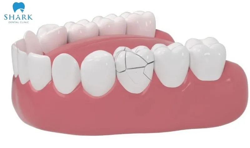 Răng sứ mẻ, vỡ xuất phát từ nhiều nguyên nhân khác nhau