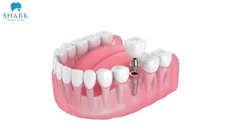 Nếu bọc sứ nhiều lần không thành công và gây tổn thương cho răng thật, bác sĩ sẽ đề xuất phương án trồng răng Implant