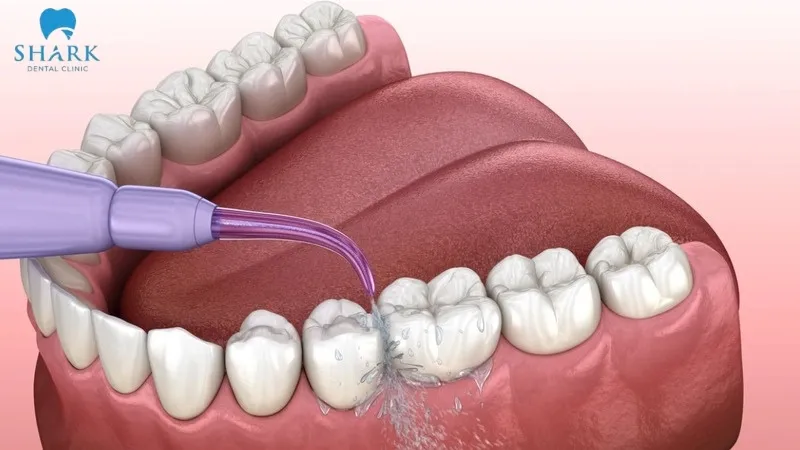 Nên dùng thêm tăm nước để loại bỏ mảng bám hiệu quả