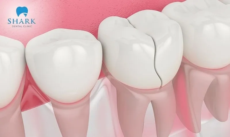 Làm răng sứ khi về già có sao không? Nên chọn loại sứ nào? 7 Răng bị nứt do yếu hoặc tai nạn có thể được khuyến khích bọc răng sứ để phục hồi chức năng ăn nhai