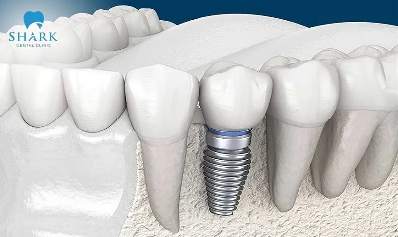 Làm răng sứ khi về già có sao không? Nên chọn loại sứ nào? 10 Cấy ghép implant giúp ngăn ngừa tình trạng tiêu xương xảy ra