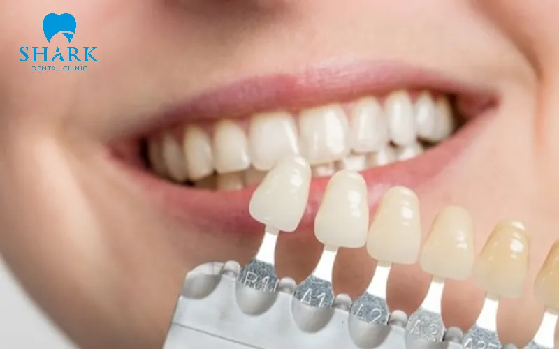 bác sĩ sẽ dùng bộ so màu chuyên dụng để xá định màu rồi mang đi chế tác