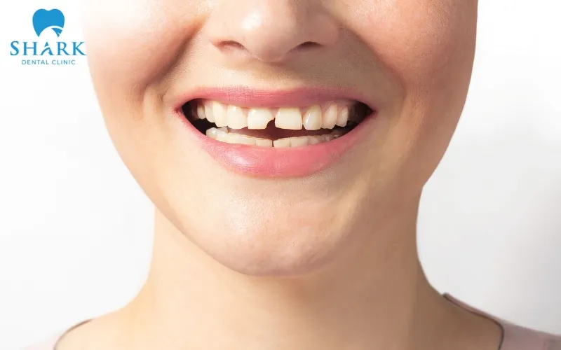 Người có răng sứt vỡ, thưa thớt và ố vàng có thể tham khảo thực hiện bọc sứ Nacera