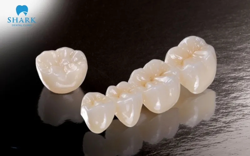 Bọc răng sứ Venus là gì? Có tốt không? Giá bao nhiêu? 11 Trên thị trường hiện nay có 4 loại răng sứ phổ biến với nhiều ưu điểm nổi bật khác nhau