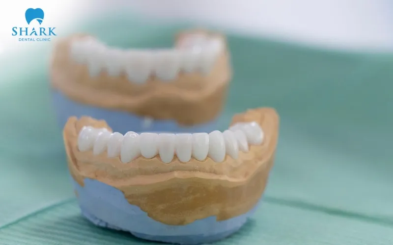 Bọc răng sứ Venus là gì? Có tốt không? Giá bao nhiêu? 14 Răng bọc sứ Venus còn nhiều nhược điểm liên quan đến khả năng chịu lực cũng như mức độ mài mòn răng
