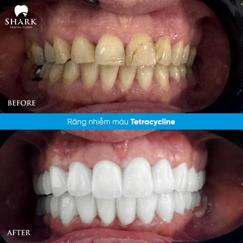 Bọc răng sứ Venus là gì? Có tốt không? Giá bao nhiêu? 15 Răng sứ nhiễm màu Tetracycline và ảnh hưởng nhiều đến tính thẩm mỹ là một trong những trường hợp nên ưu tiên bọc sứ Venus