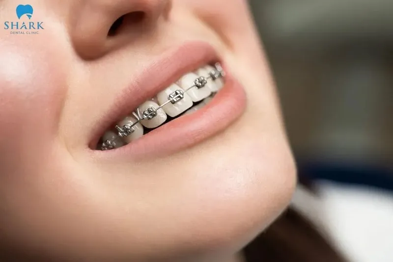 Răng trám có niềng được không? Cần lưu ý gì? 5 Trám răng rồi có niềng được không là thắc mắc của nhiều khách hàng
