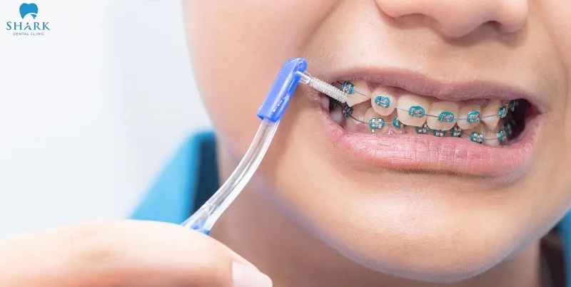 Răng trám có niềng được không? Cần lưu ý gì? 6 Nên dùng dụng cụ làm sạch răng niềng chuyên dụng để loại bỏ mảng bám hiệu quả